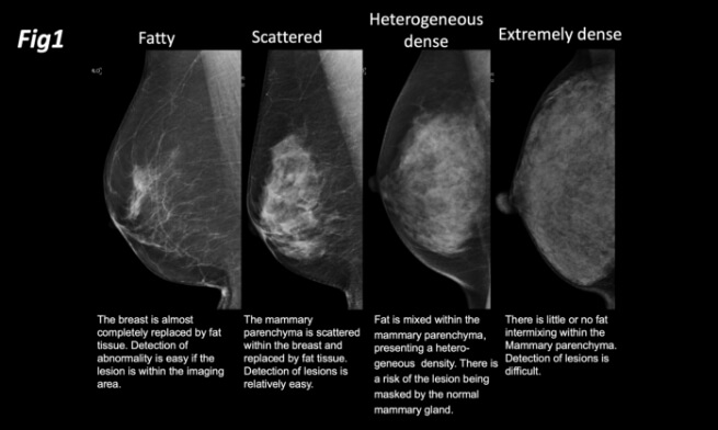 乳房構成の定義