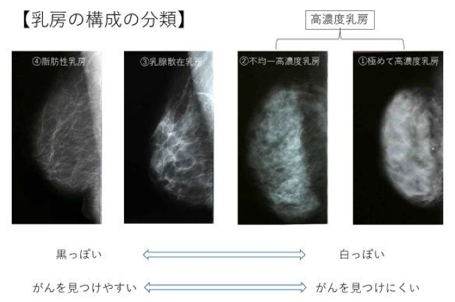 乳房の構成の分類